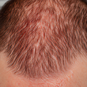 A close-up of a scalp with patches of red and white skin.