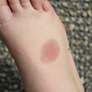 A close-up of a foot with red patches of skin.