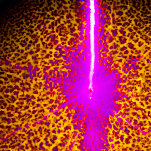 A bright yellow cross-section of skin with a purple laser beam emanating from it.