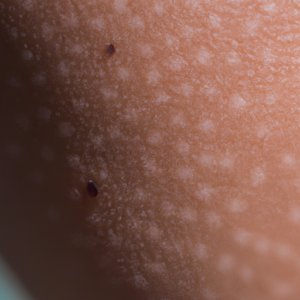 A close-up of a sun-drenched freckle or mole on the skin.