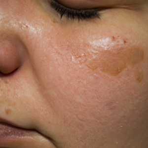 A close-up of a person's face with patches of discolored skin.