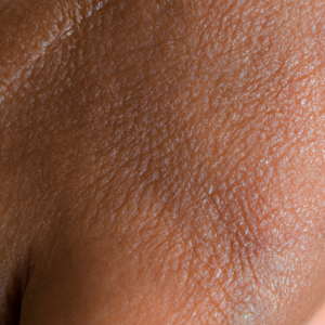 A close-up of a person's skin showing a dark splotch or discoloration.