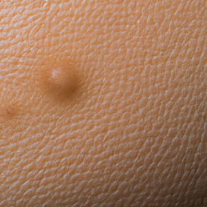 A close-up of an area of skin with a dark, circular spot.